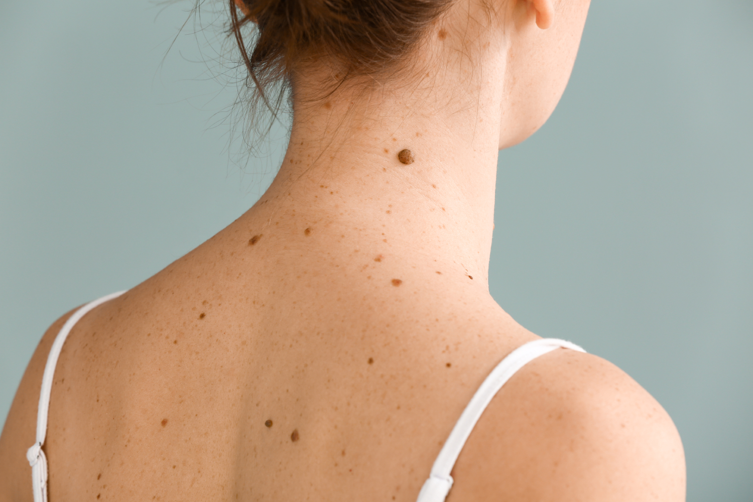 Mole Removal: Enhancing Skin Confidence at Cultura Cosmetic Dermatology & Laser Center