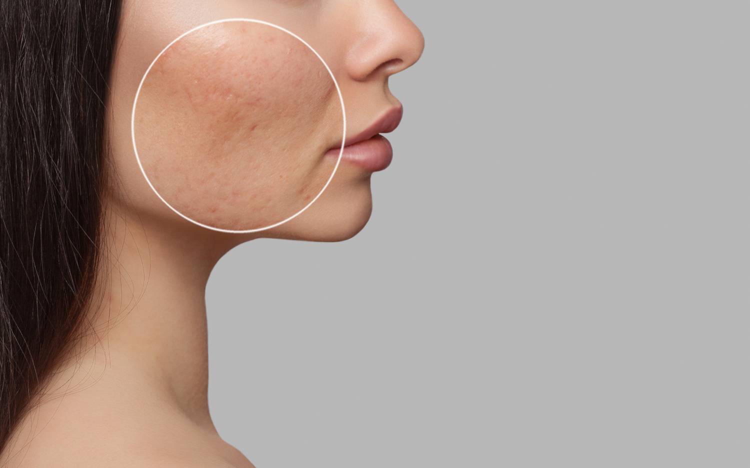 Effective Acne and Scar Treatments at Cultura Cosmetic Dermatology & Plastic Surgery