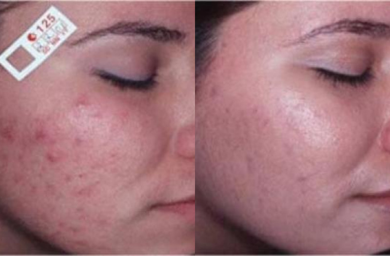 Acne Therapy 125 Combine Image