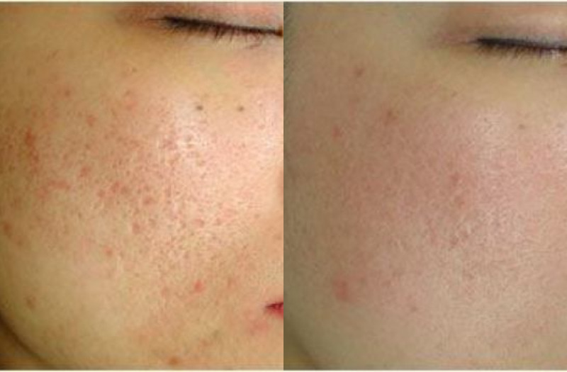 Acne Therapy 132 Combine Image