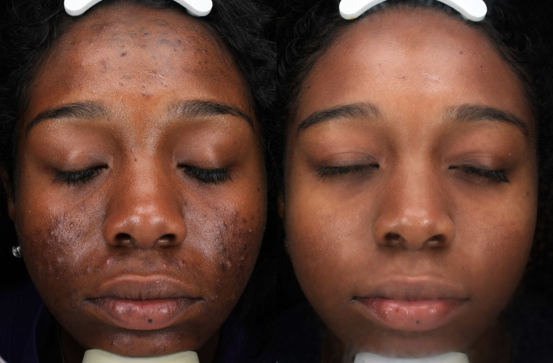 Acne Therapy 267 Combine Image