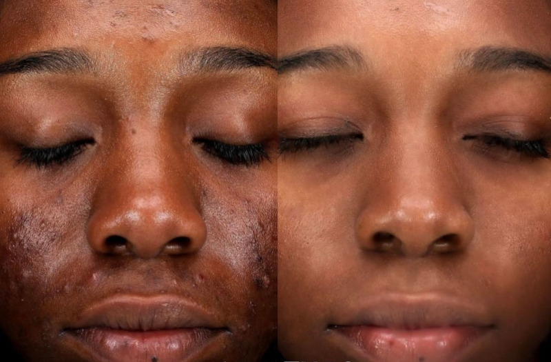 Complexion Blending 42 image