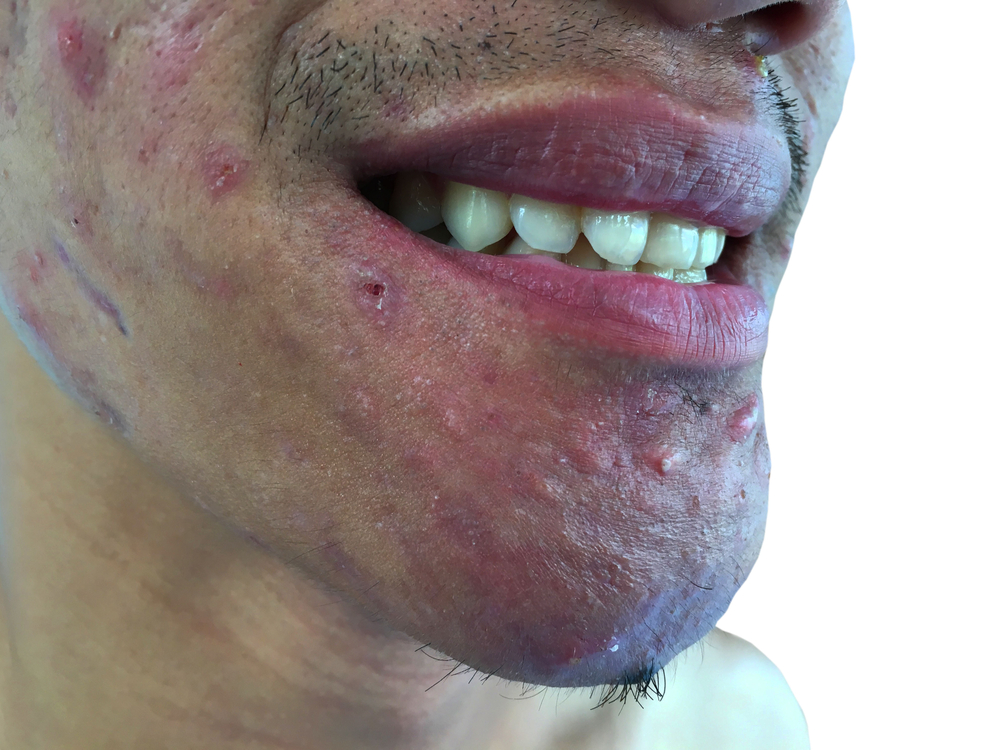 Get Rid of Acne Scars | | Cultura Dermatology & Laser Center Washington DC
