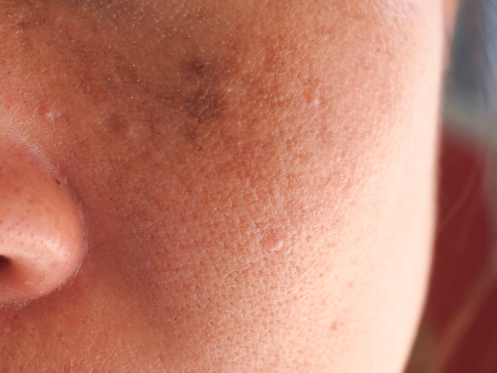 The Differences Between Melasma And Typical Hyperpigmentation And How