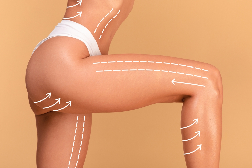 Maryland's Best Lipo 360 / Liposuction Results!
